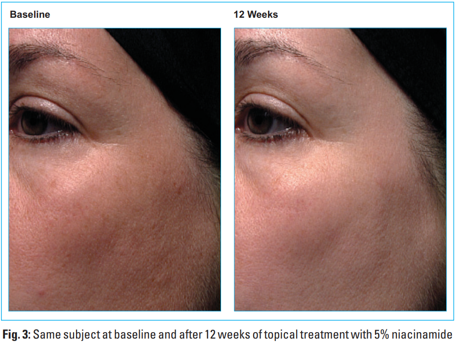 niacinamide 5