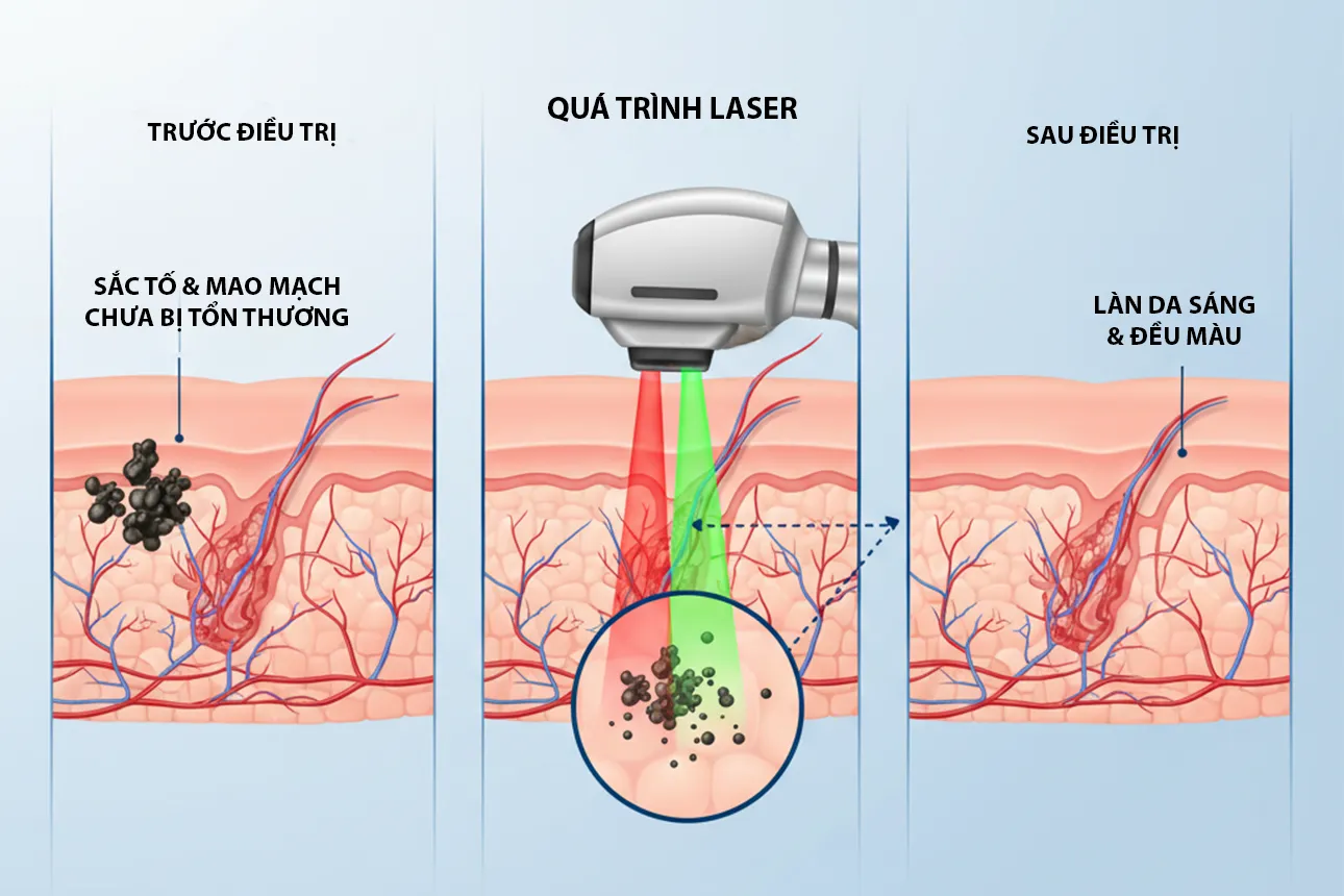 cach phuc hoi da sau laser hoac dieu tri bang anh sang ipl 2