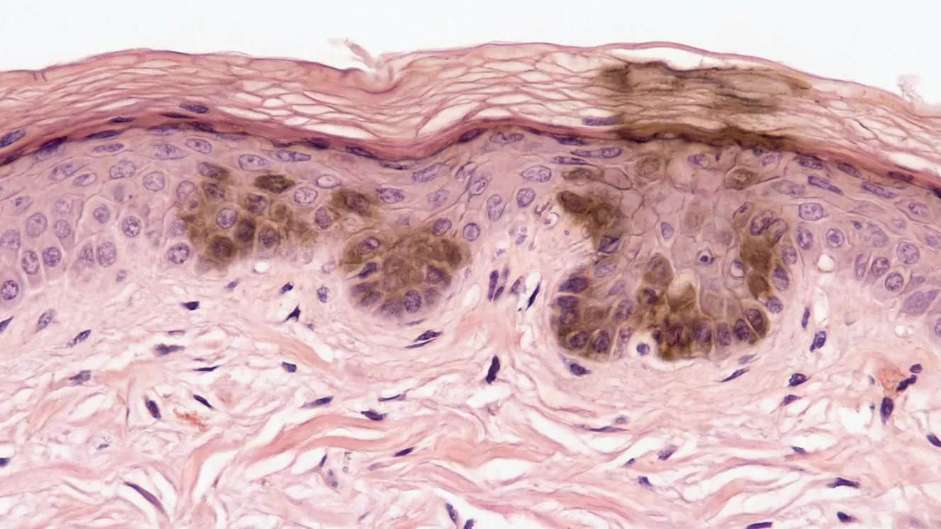 lao hoa quang hoc la gi va lam sao de ngan chan 2